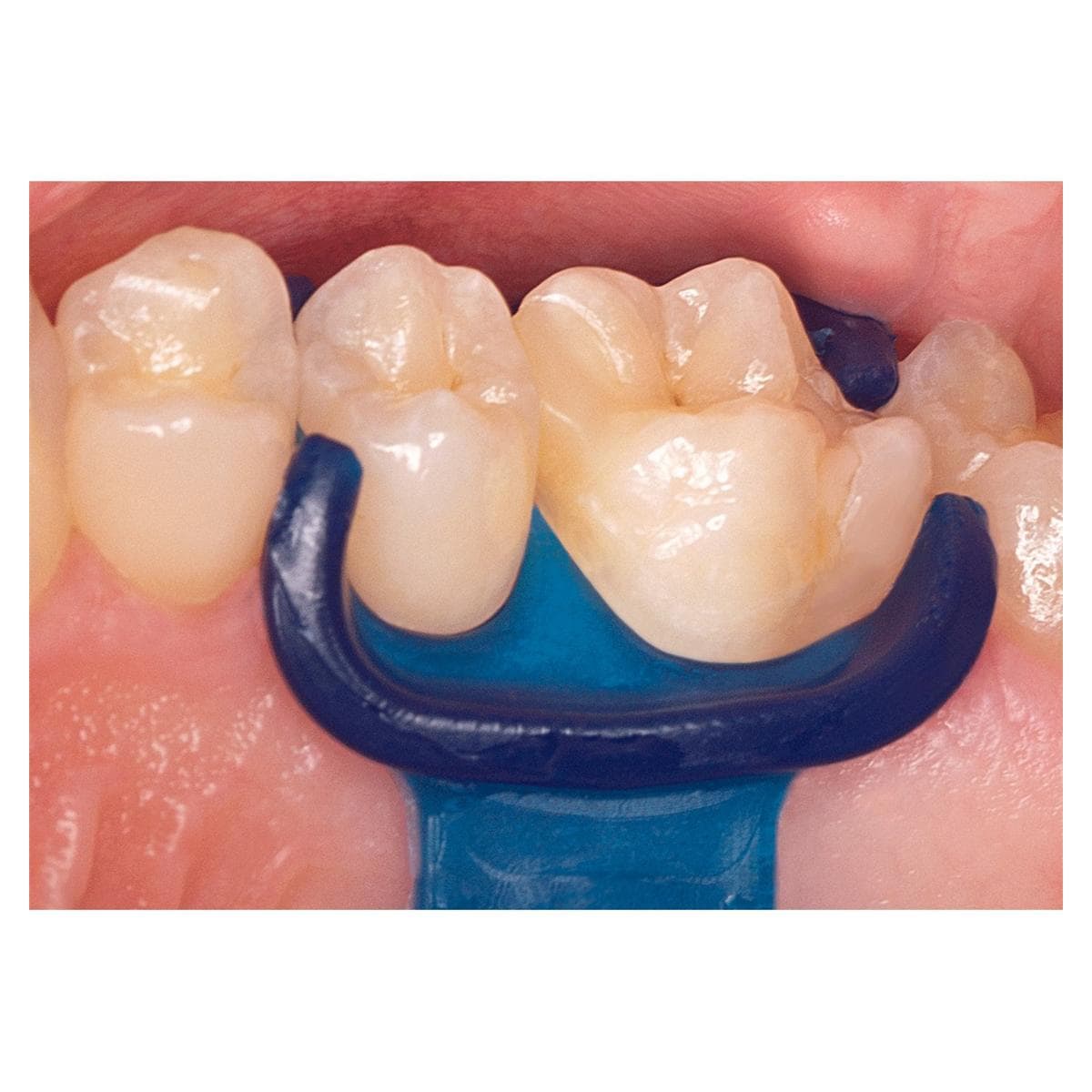 DMG Minidam – Latexvrij Siliconen Schild voor Proximale Isolatie-DMG-Sordent