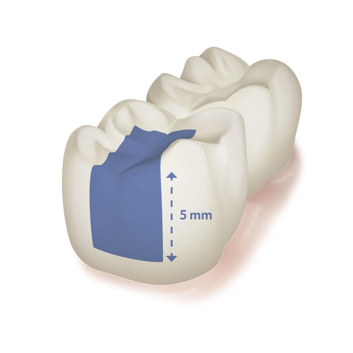 DMG Ecosite Bulk Fill Safetips Light | 16 × 0,25 g-DMG-Sordent