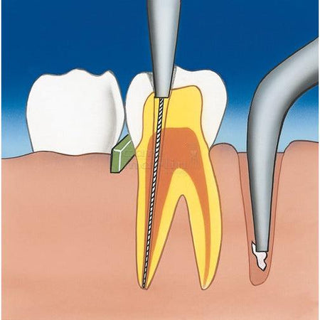 Carl Martin Wortelkanaal Endotang / Root Canal Plier #1206-Carl Martin-Sordent