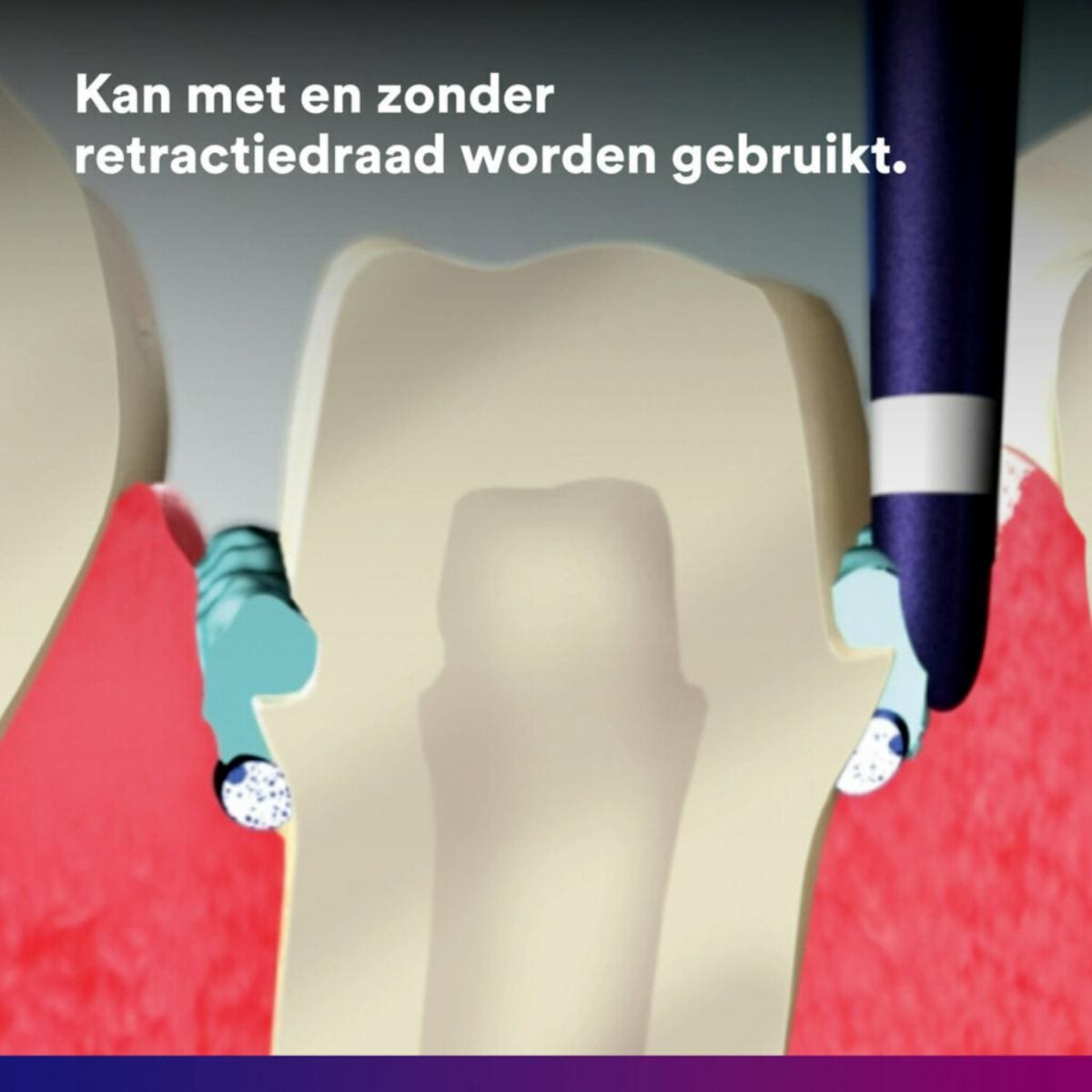 3M™ Astringent Retractiepasta - Value Pack - (100 Capsules)-Solventum-Sordent