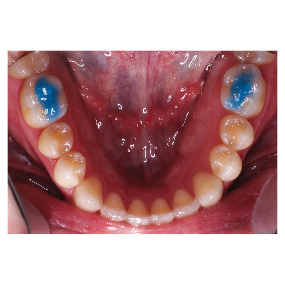 Reliance Ultra Band-Lok Blauw (Zonder Fluoride) UBL-Reliance-Sordent