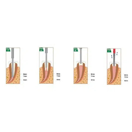 DiaDent Duo-Gun: Draadloos Backfill Obturatieapparaat-DiaDent-Sordent