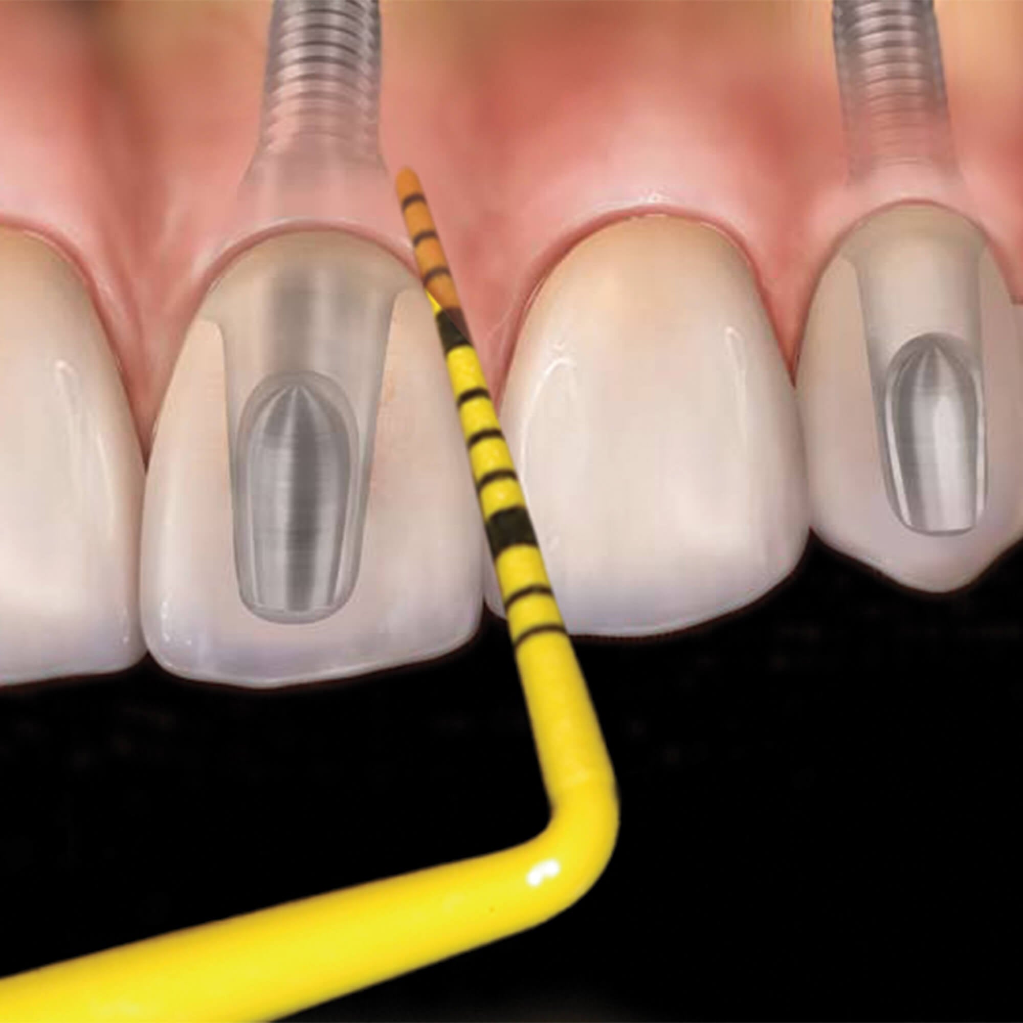 Hu-Friedy Pocketsonde Williams Colorvue™ Kit-Hu-Friedy-Sordent