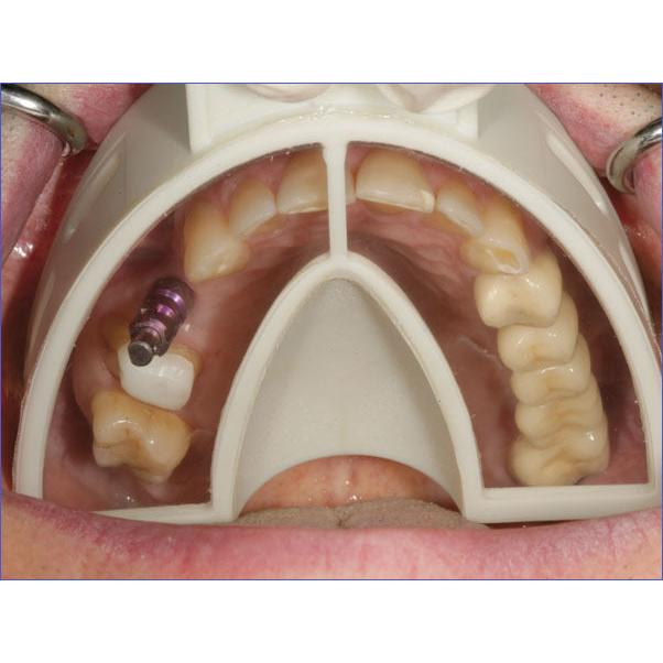 Hager & Werken Miratray® Implant Disposable Afdruklepels (6 st.)-Hager & Werken-Sordent