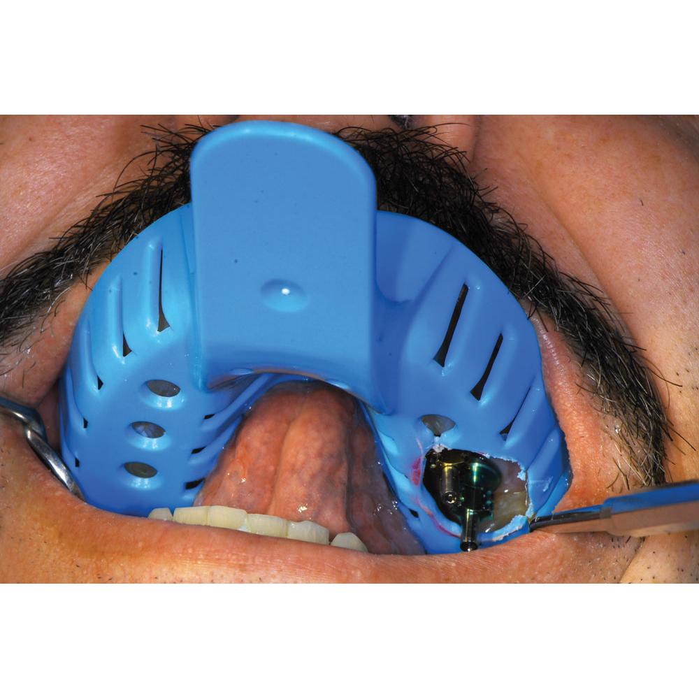 Hager & Werken Miratray® Implant Disposable Afdruklepels (6 st.)-Hager & Werken-Sordent