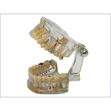 Hager & Werken Studiemodel Transparant Plus - Met tandaandoeningen-Hager & Werken-Sordent