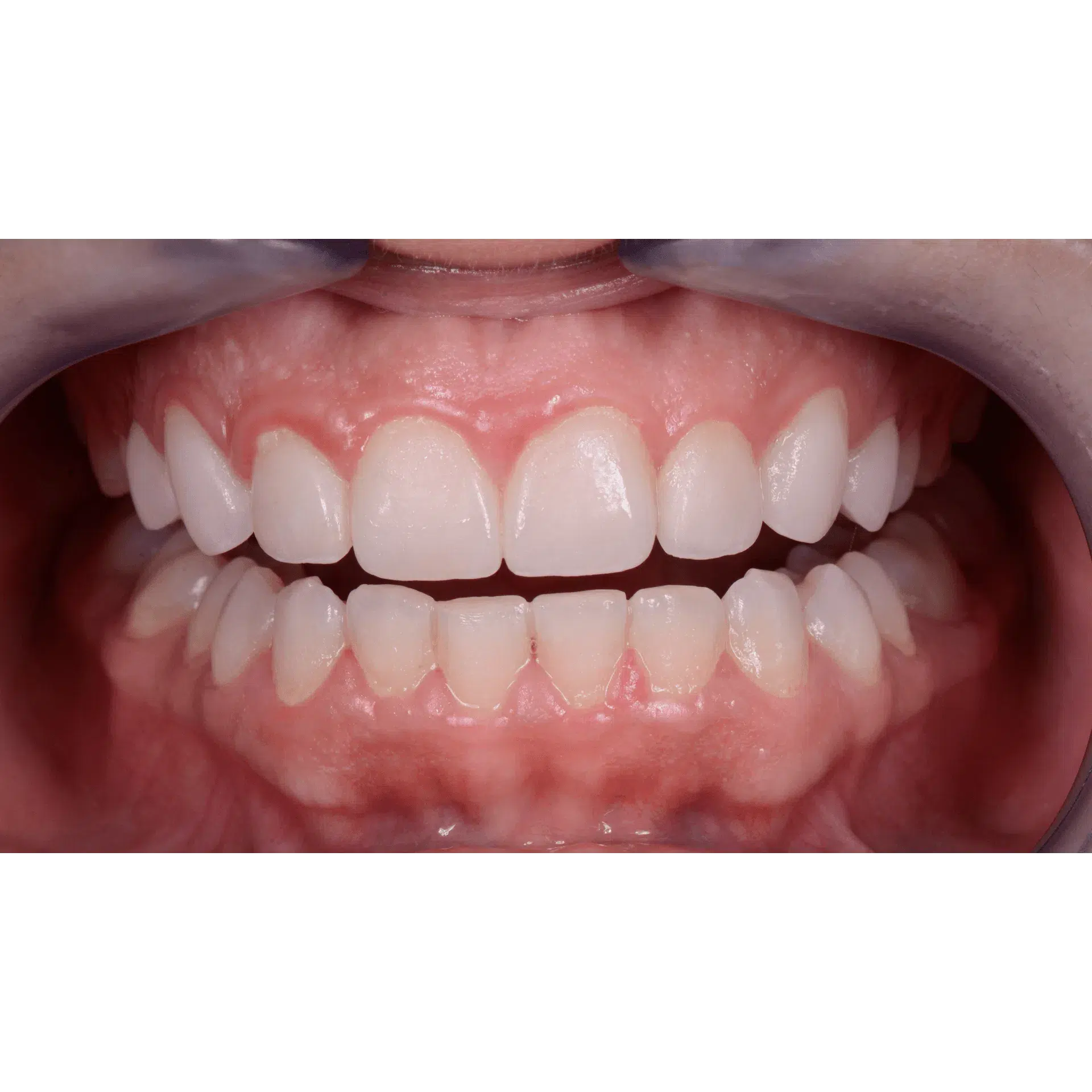 EMS Biofilm Discloser / Disclosing Pellets Plaqueverklikker (250 st.)-E.M.S.-Sordent