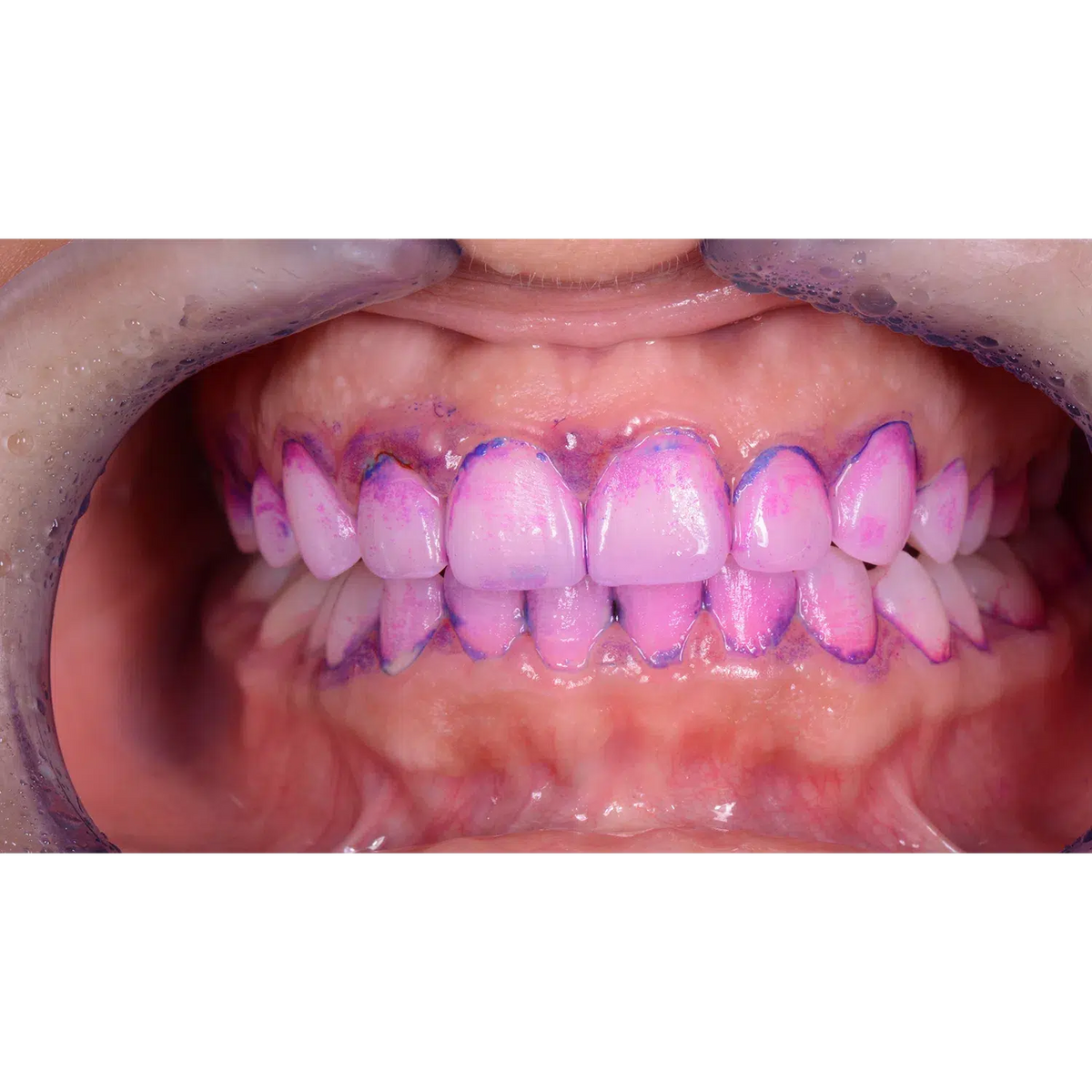 EMS Biofilm Discloser / Disclosing Pellets Plaqueverklikker (250 st.)-E.M.S.-Sordent