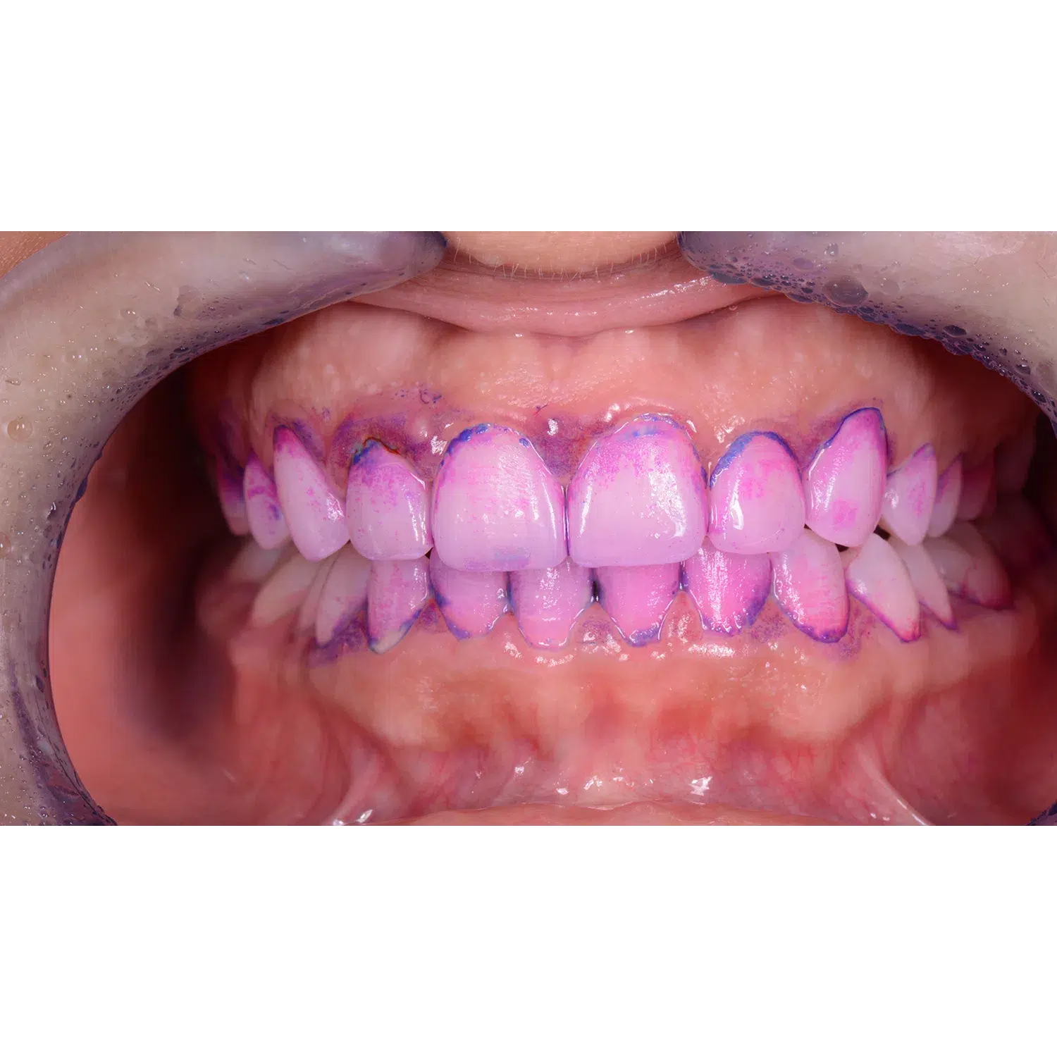 EMS Biofilm Discloser / Disclosing Pellets Plaqueverklikker (250 st.)-E.M.S.-Sordent