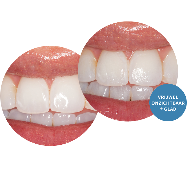 Enamelast™ Fluoridelak - Unit-Dose - 5 Smaken - (50/200 st.)-Ultradent-Sordent