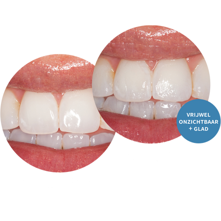 Enamelast™ Fluoridelak - Unit-Dose - 5 Smaken - (50/200 st.)-Ultradent-Sordent